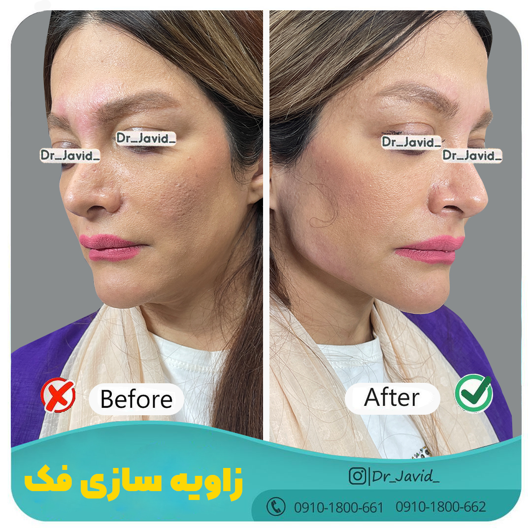 زاویه سازی صورت